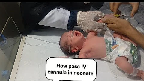 How to Pass an IV Cannula in an Infant: Step-by-Step Method for Health Professionll neonatal care