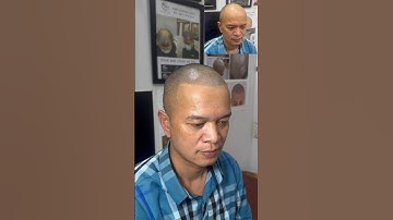 Cách để lập tức hết hói đầu tóc thưa