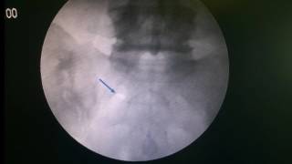 S1 foraminal injection