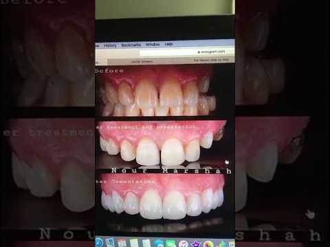 العدسات التجميلة للاسنان تتحدث عنها الدكتوره نور مرشحة في سناب