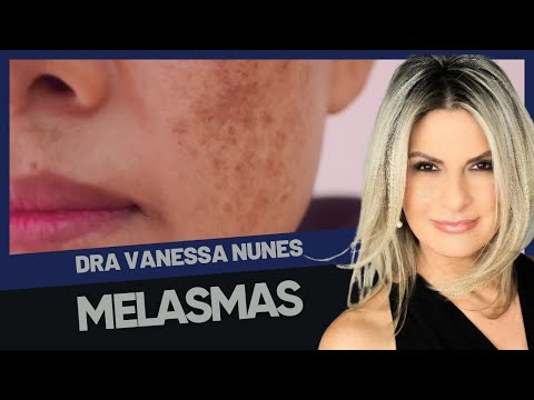 🔥 Melasma: Como Tratar e Prevenir as Manchas na Pele? Saiba Tudo!