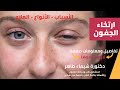 ارتخاء الجفون الأسباب الأنواع والعلاج دكتورة شيماء طاهر استشارى طب وجراحة العيون 
