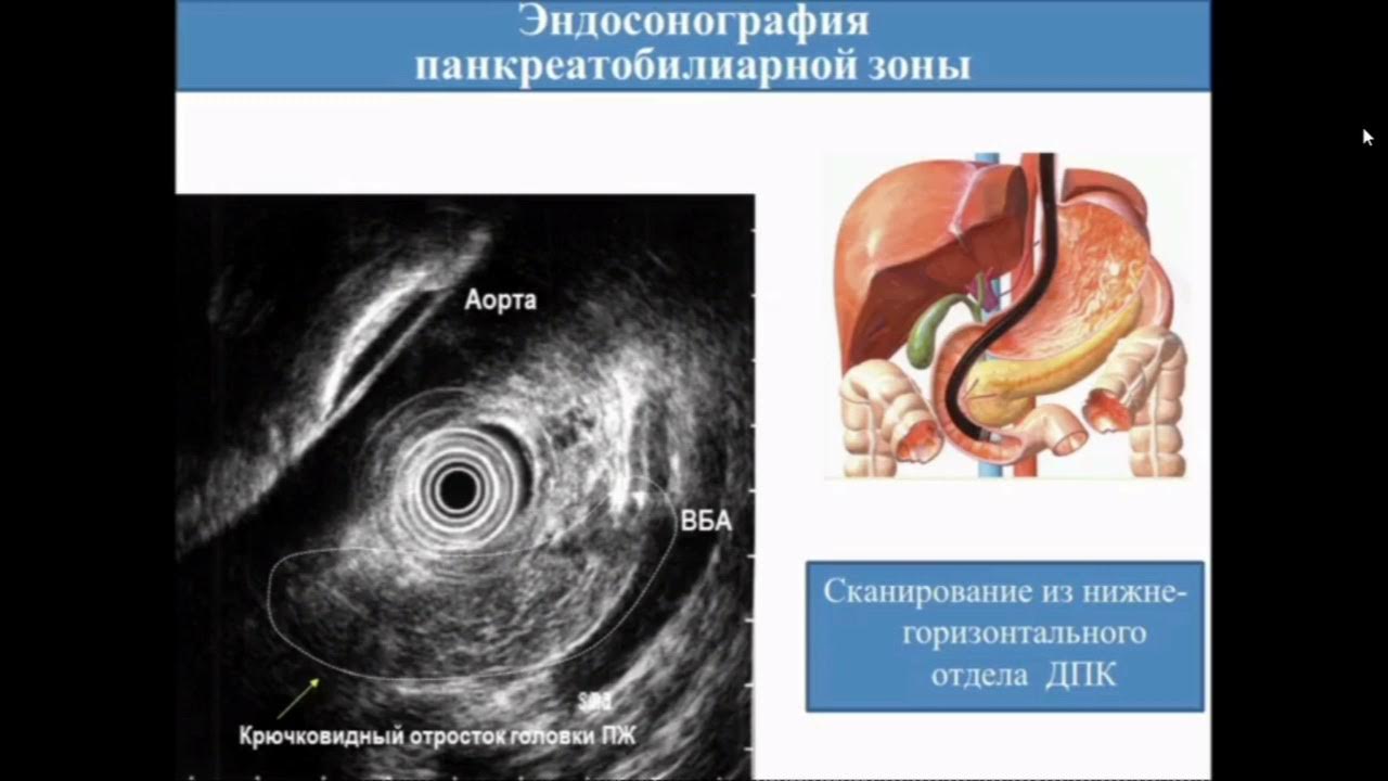 Узи эндоскопия. Эндоскопическая ультрасонография поджелудочной железы. Эндоскопическое ультразвуковое исследование (ЭНДОУЗИ). Эндосонография желудка.