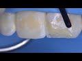 How to create an anterior restoration with multiple Mosaic composite shades