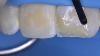How to create an anterior restoration with multiple Mosaic composite shades screenshot 4