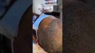 🔥 The Secret Behind a Natural-Looking Hair Transplant! #hairtransplant