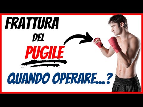 Frattura del pugile (frattura del quinto metacarpo)