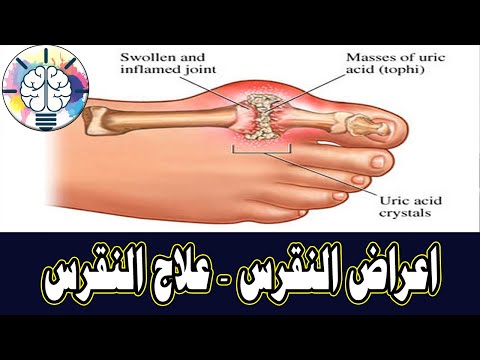 لماذا اصيبت بالنقرس في اصبع قدمي الكبير