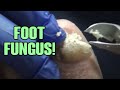 Sailor Finds Fungal Fix For Foot!