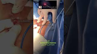 Lateral Internal sphincterotomy-Dr.Arkan Zuhair Ibraheem عملية الشرخ الشرجي المزمن د.اركان زهير