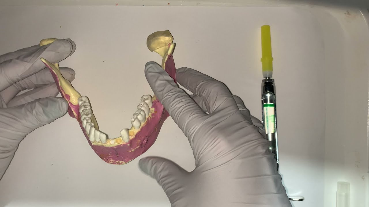 Bloqueo del nervio alveolar inferior// Método directo e indirecto