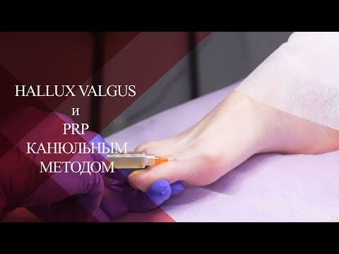 💉 Вальгусная деформация стопы и лечение PRP методом канюльной техникой| Hallux valgus и PRP