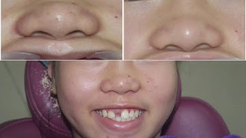 CHỈNH NHA KÉO RĂNG NGẦM TẠI NHA KHOA ĐỨC TUYẾN.