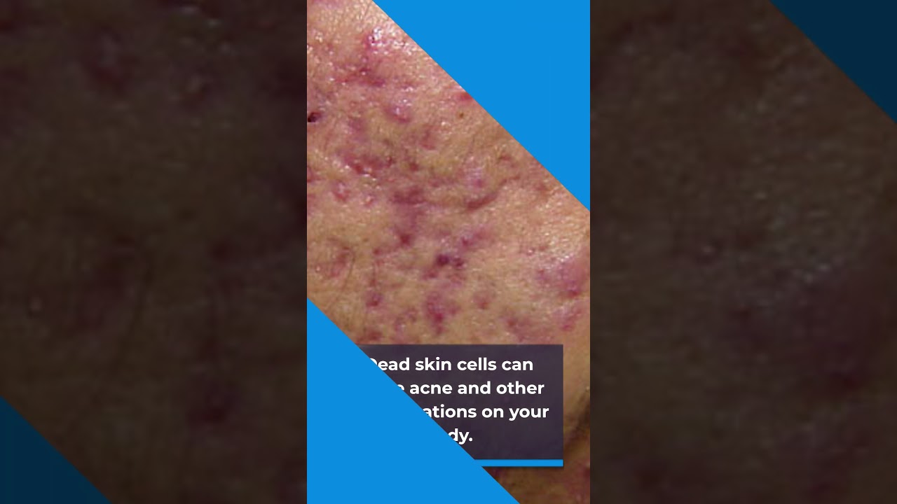 Dead skin cells are the dust in your house