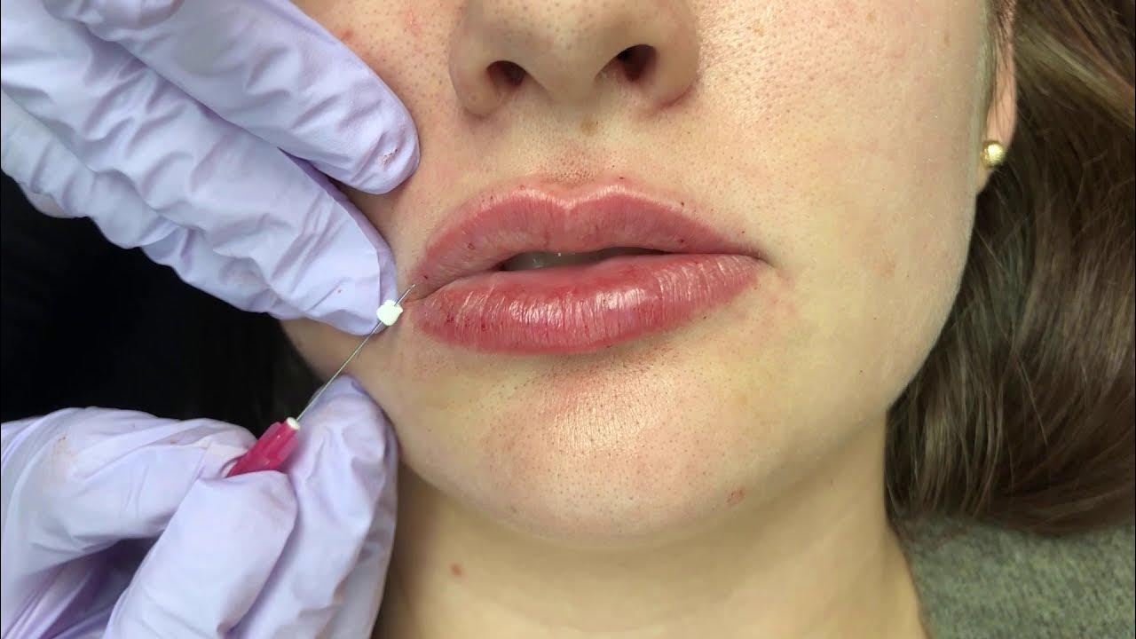 Using VSoft Lift Smooth PDO Threads in Lips YouTube