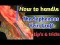How to harvest and handle the Saphenous Vein Graft. Tips and tricks #saphenousveingraft