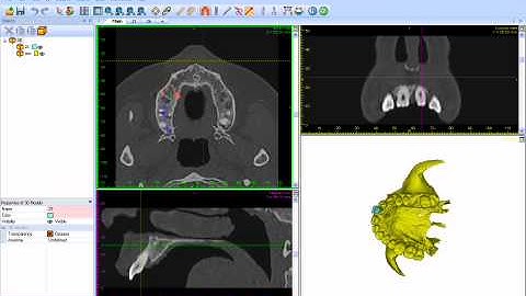 Panoramic curve on maxilla.