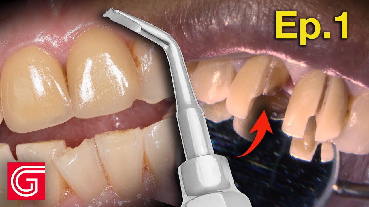 HOW TO Remove OLD ZIRCONIA Crowns | Ep 1