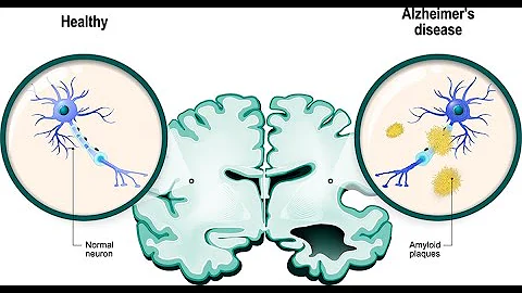 Revolutionizing Alzheimer’s: Microglia's Role in Amyloid Clearance