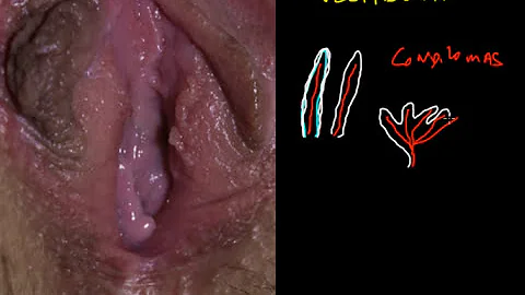 O que causa a papilomatose vestibular?