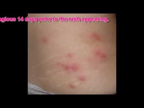 Shingles Rash Facts & Pictures