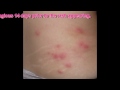 Shingles Rash Facts & Pictures