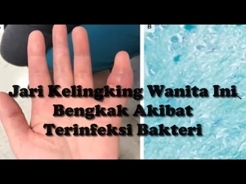 Video: Ujung Jari Bengkak: Penyebab, Pengobatan, Kapan Harus Mencari Bantuan