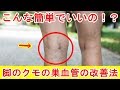 【美脚】クモの巣状静脈瘤改善の３つの方法　【ワールドわんだふる】