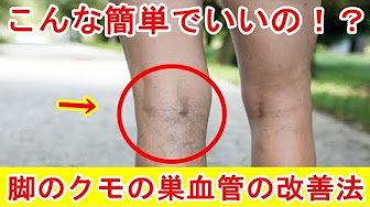 静脈瘤 Youtube