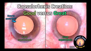 Capsulorhexis: Good vs Great