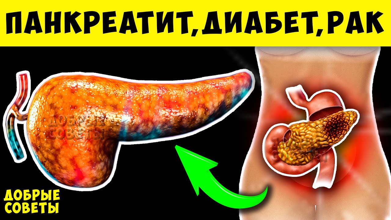Симптомы Болезни Поджелудочной Железы, что Запрещено при Панкреатите ...