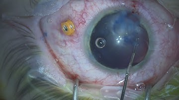 Intraocular Foreign Body Removal with Magnet