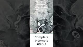 Complete bicornate uterus (Bicorns unicolis)