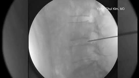 C-arm images for lumbar YESDISC procedure