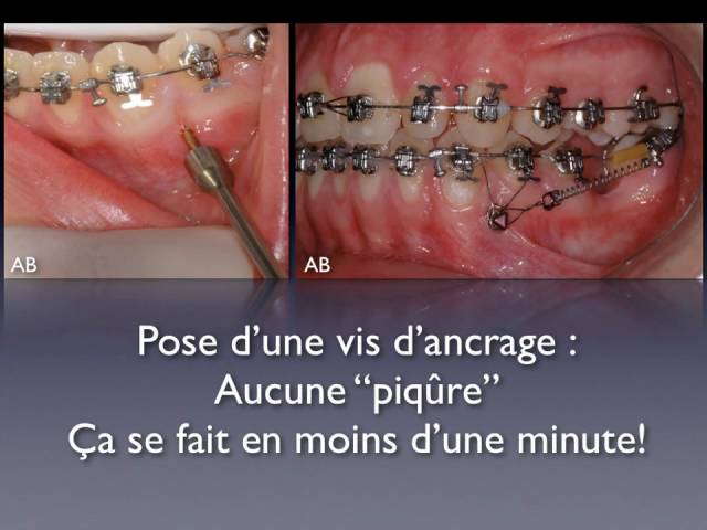 Mini-vis d'ancrage en orthodontie orthoLemay.com.mov 