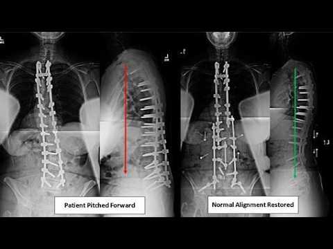 Harrington rod for scoliosis; spinal instrumentation to treat scoliosis ...