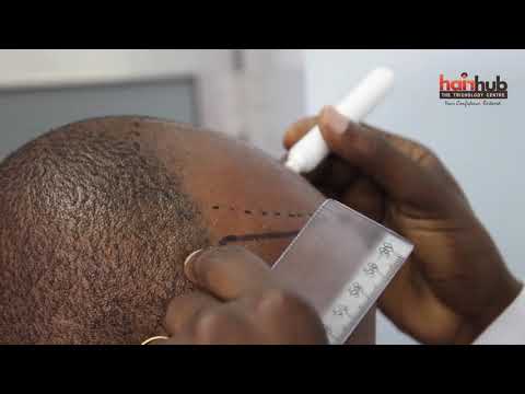 How a hair transplant is mapped