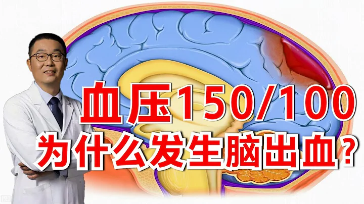 血壓150.100，卻發生了腦出血，原因是什麼？醫生說出其中原因 - 天天要聞