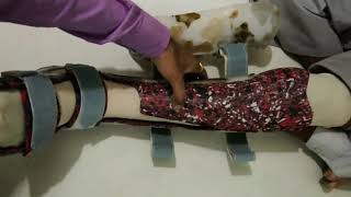 Charcot Walker By Dr Hiren Babariya-Prosthetist And Orthotist-Gold Medalist, Inspire Health Care