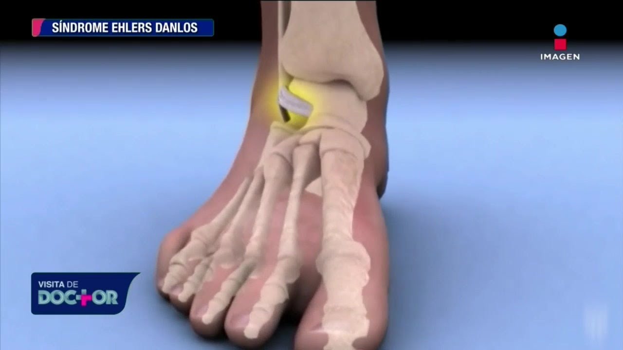 Síndrome Ehlers Danlos descubre sus síntomas y características Visita de Doctor YouTube