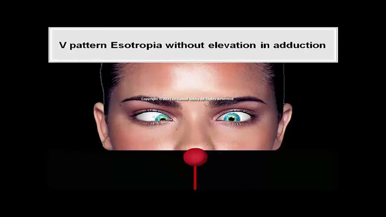 19 A and V Patterns Animated Book Binocular Vision and Ocular Motility