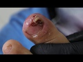Ep_640 Nail treatment extreme infected ingrown 👣 เจ็บเล็บ เจ็บแผล ต่างกันอย่างไร?