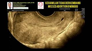 Miscarriage 8 weeks Miscarriage 8 weeks