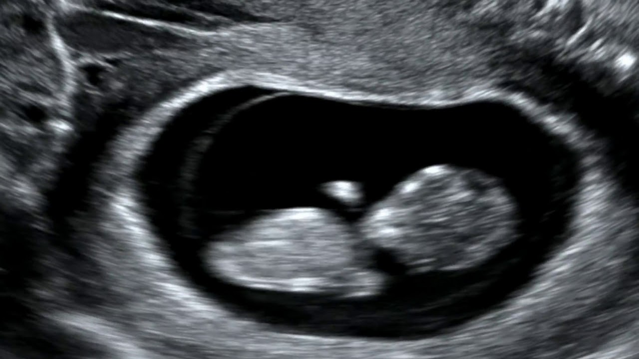 sonogram picture