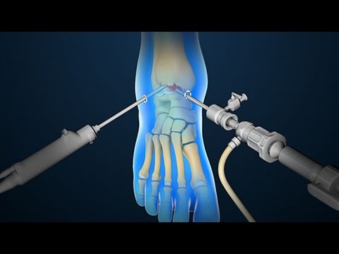 Ankle Scope | Arthroscopy | Nucleus Health - YouTube