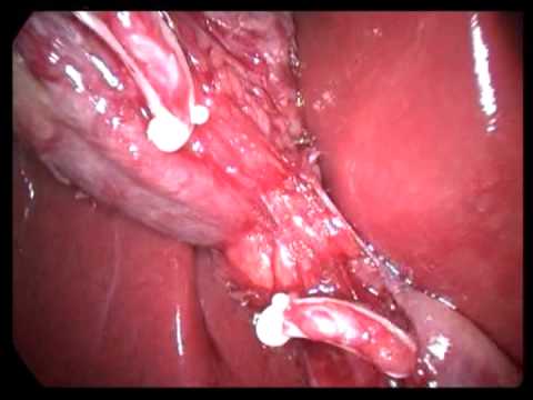 Laparoscopic Cholecystectomy (unedited-67)-Simple, Managing GB Perforation During Surgery