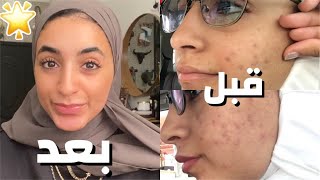 كيف تخلصت من حب الشباب مجاناً ؟| فيديو البشرة ( نتيجه مضمونه )