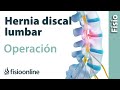 Hernia discal lumbar - Operación quirúrgica o cirugía