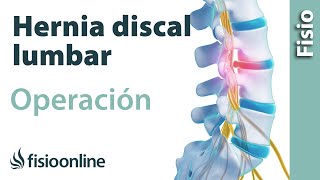 Hernia discal lumbar - Operación quirúrgica o cirugía