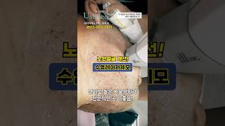 강남레이저제모 깜끔함으로 세상편함! #shorts #레이저제모